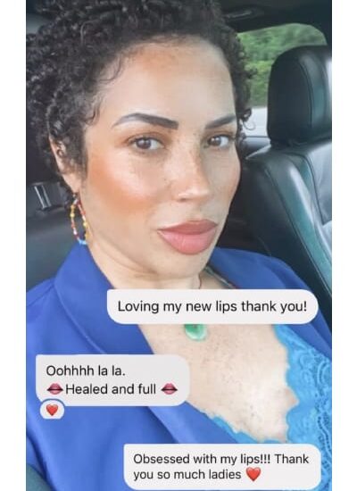 Lip Treatment Client Reviews In Brooklyn, NY & Aventura, FL | Beauty Injector NYC