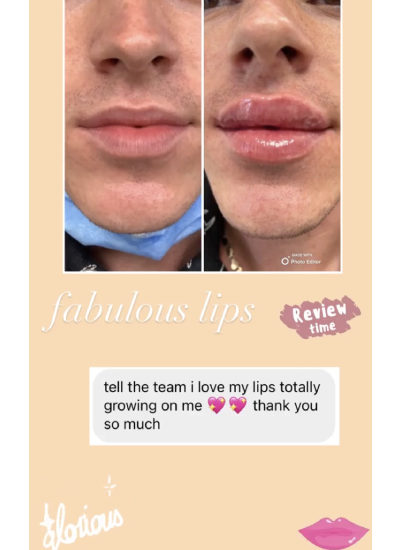 Lip Before & After Treatment Client reviews In Brooklyn, NY & Aventura, FL | Beauty Injector NYC