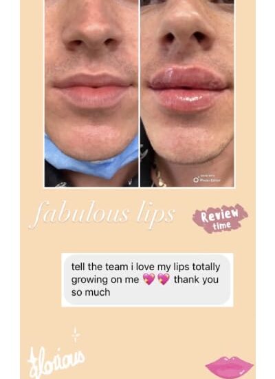 Lip Before & After Treatment Client reviews In Brooklyn, NY & Aventura, FL | Beauty Injector NYC