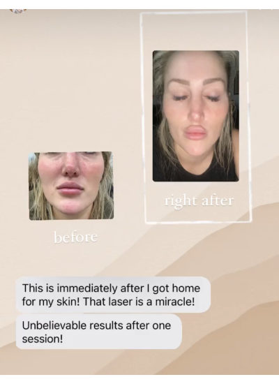 Lip Treatment Client reviews Before & After Photos In Brooklyn, NY & Aventura, FL | Beauty Injector NYC