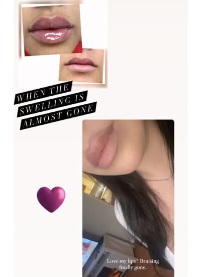 Lip Treatment client reviews In Brooklyn, NY & Aventura, FL | Beauty Injector NYC