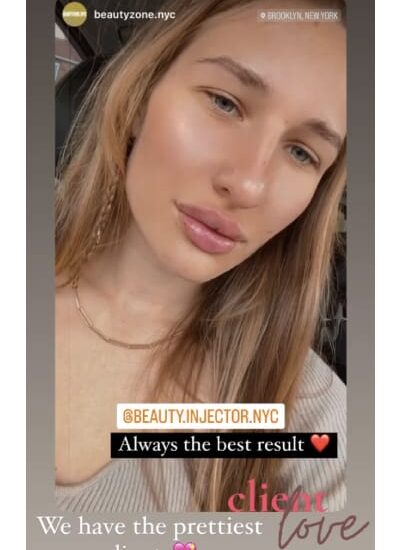 Lip Treatment In Brooklyn, NY & Aventura, FL | Beauty Injector NYC